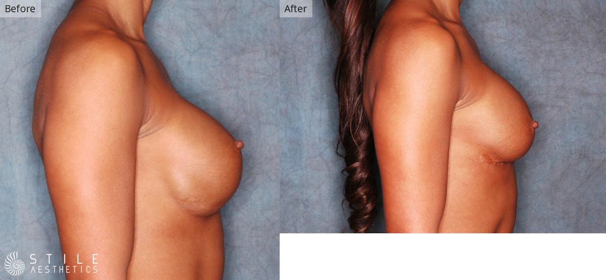 Breast Revision Surgery Before & After Gallery - Patient 926239 - Image 2