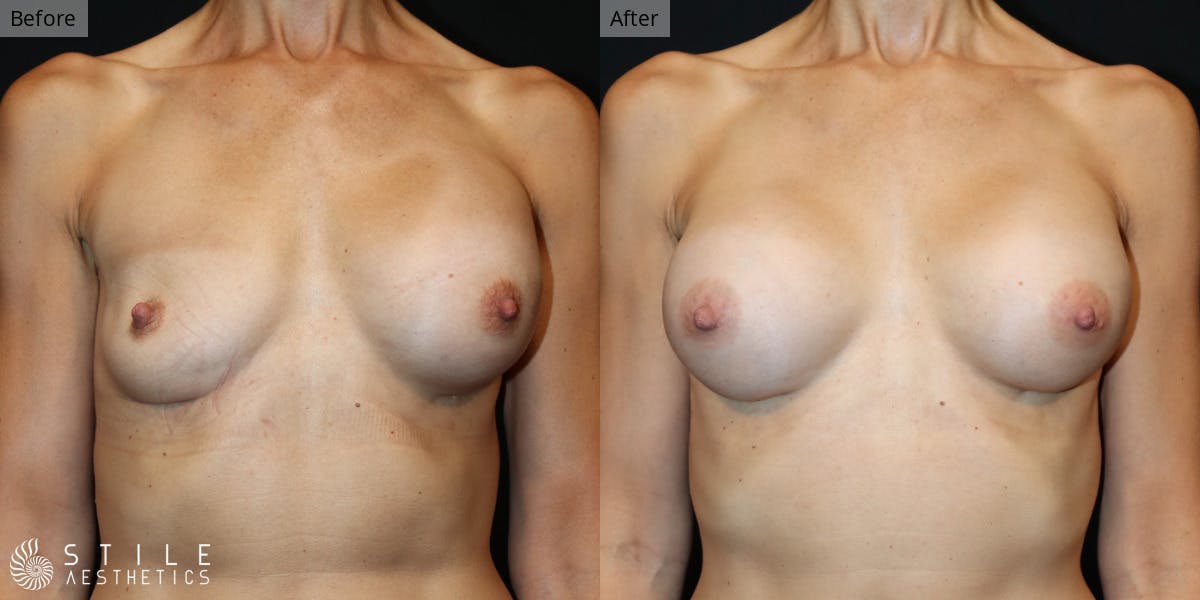 Breast Revision Surgery Before & After Gallery - Patient 236567 - Image 1