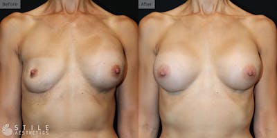 Breast Revision Surgery Before & After Gallery - Patient 236567 - Image 1