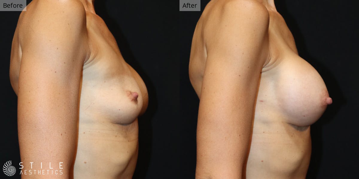 Breast Revision Surgery Before & After Gallery - Patient 236567 - Image 2