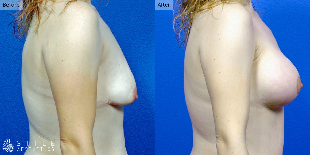 Breast Revision Surgery Before & After Gallery - Patient 528393 - Image 2