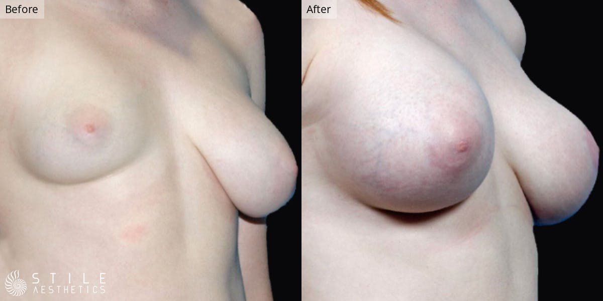 Breast Reconstruction Before & After Gallery - Patient 172317 - Image 1