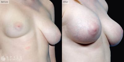 Breast Reconstruction Before & After Gallery - Patient 172317 - Image 1