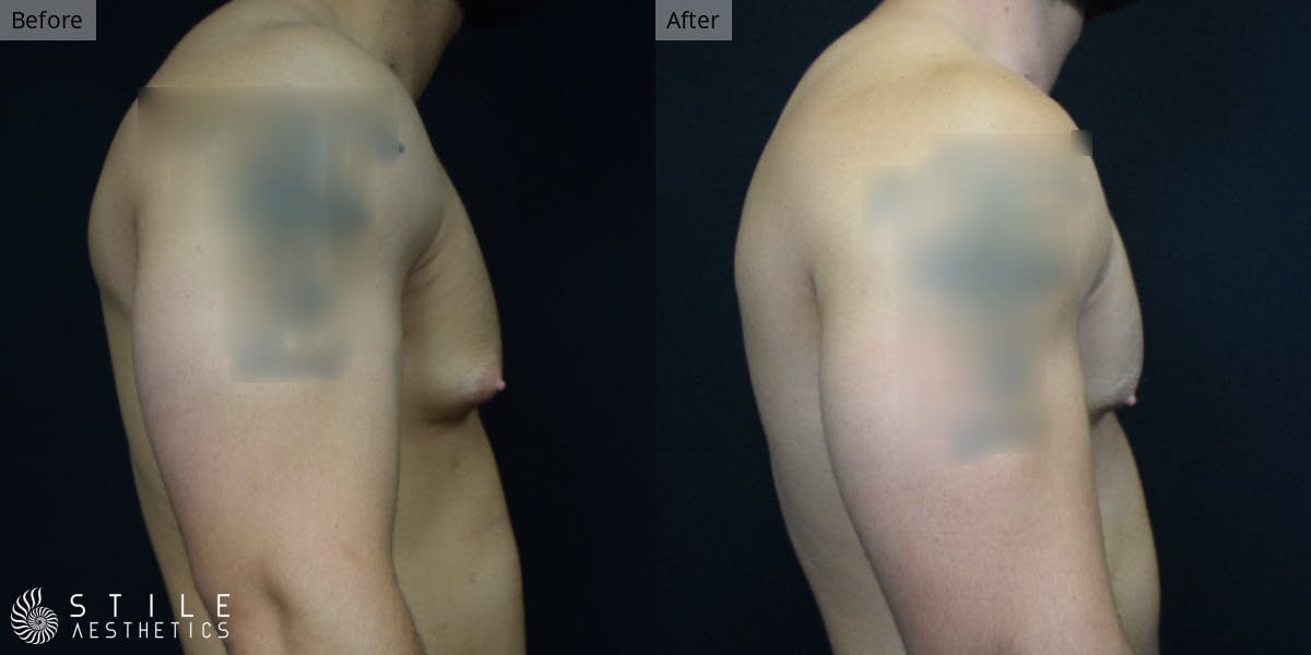 Gynecomastia Surgery Before & After Gallery - Patient 275365 - Image 1