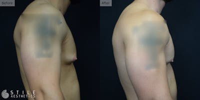 Gynecomastia Surgery Before & After Gallery - Patient 275365 - Image 1