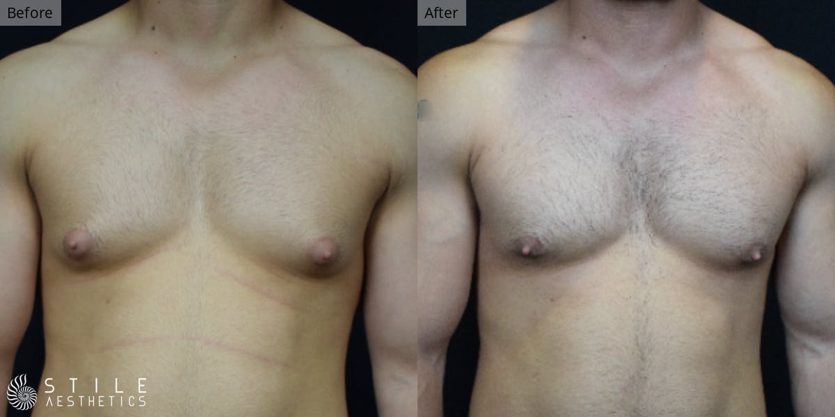Gynecomastia Surgery Before & After Gallery - Patient 275365 - Image 2
