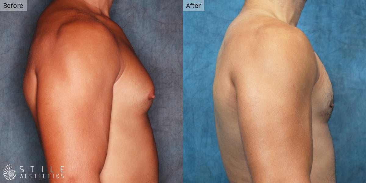 Gynecomastia Surgery Before & After Gallery - Patient 368857 - Image 1