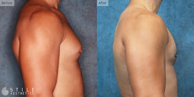 Gynecomastia Surgery Before & After Gallery - Patient 368857 - Image 1