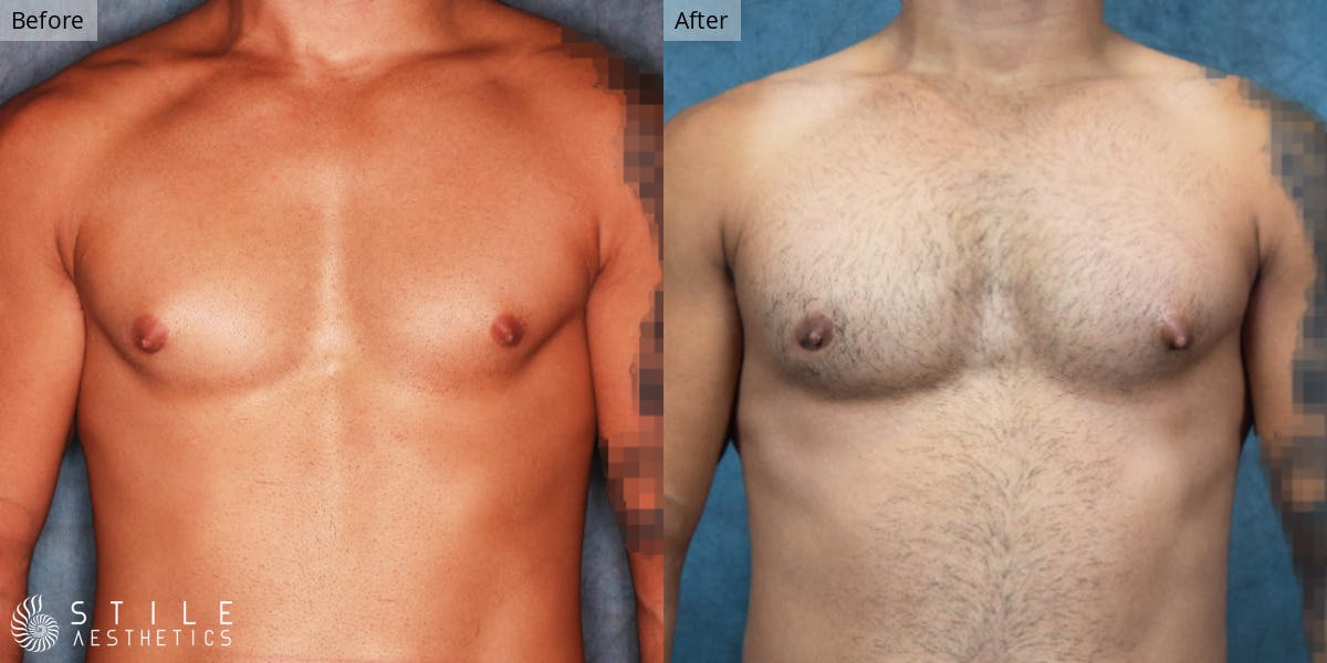 Gynecomastia Surgery Before & After Gallery - Patient 368857 - Image 2