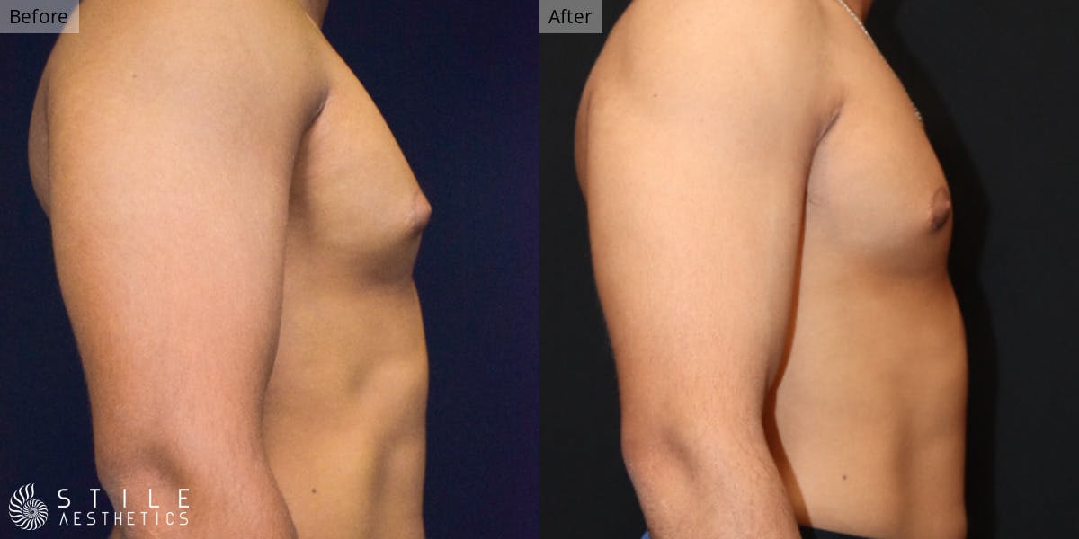 Gynecomastia Surgery Before & After Gallery - Patient 322201 - Image 1