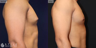 Gynecomastia Surgery Before & After Gallery - Patient 322201 - Image 1