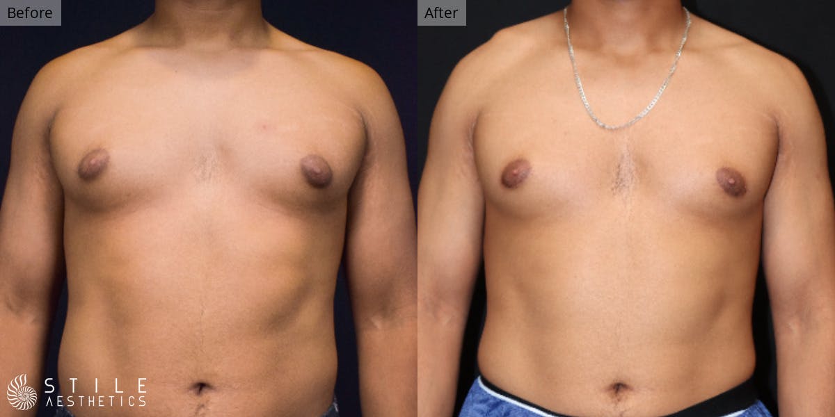 Gynecomastia Surgery Before & After Gallery - Patient 322201 - Image 2