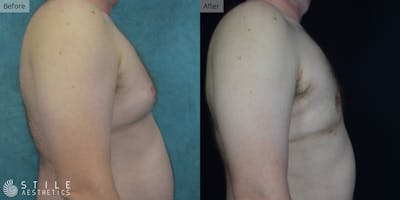Gynecomastia Surgery Before & After Gallery - Patient 274231 - Image 1
