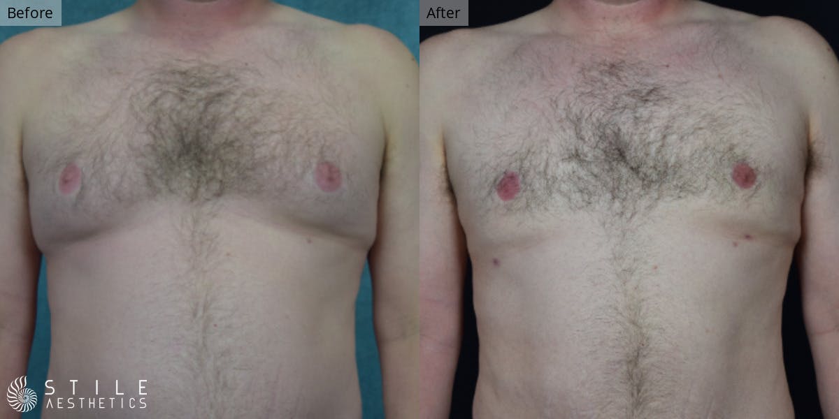 Gynecomastia Surgery Before & After Gallery - Patient 274231 - Image 2