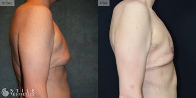 Gynecomastia Surgery Before & After Gallery - Patient 380102 - Image 1