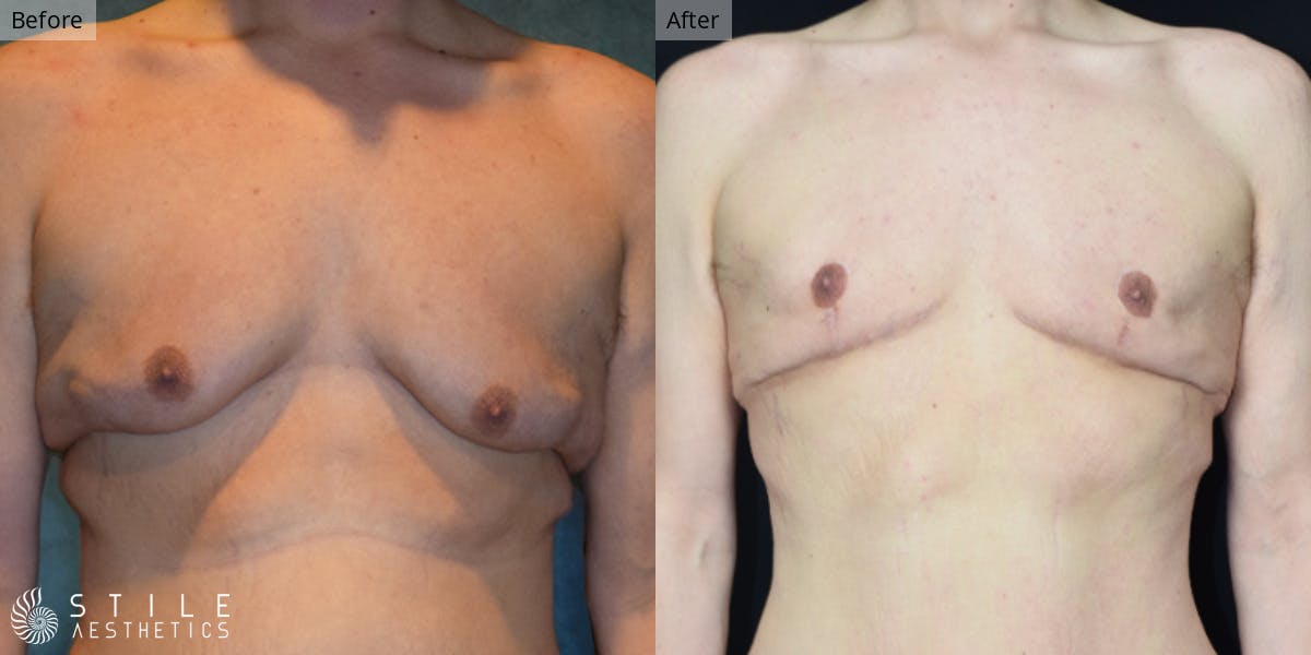 Gynecomastia Surgery Before & After Gallery - Patient 380102 - Image 2