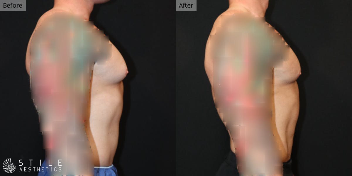 Gynecomastia Surgery Before & After Gallery - Patient 260002 - Image 1