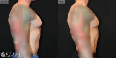 Gynecomastia Surgery Before & After Gallery - Patient 260002 - Image 1