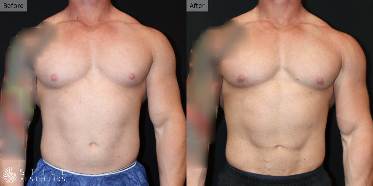 Gynecomastia Surgery Before & After Gallery - Patient 260002 - Image 2