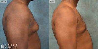Gynecomastia Surgery Before & After Gallery - Patient 197027 - Image 1