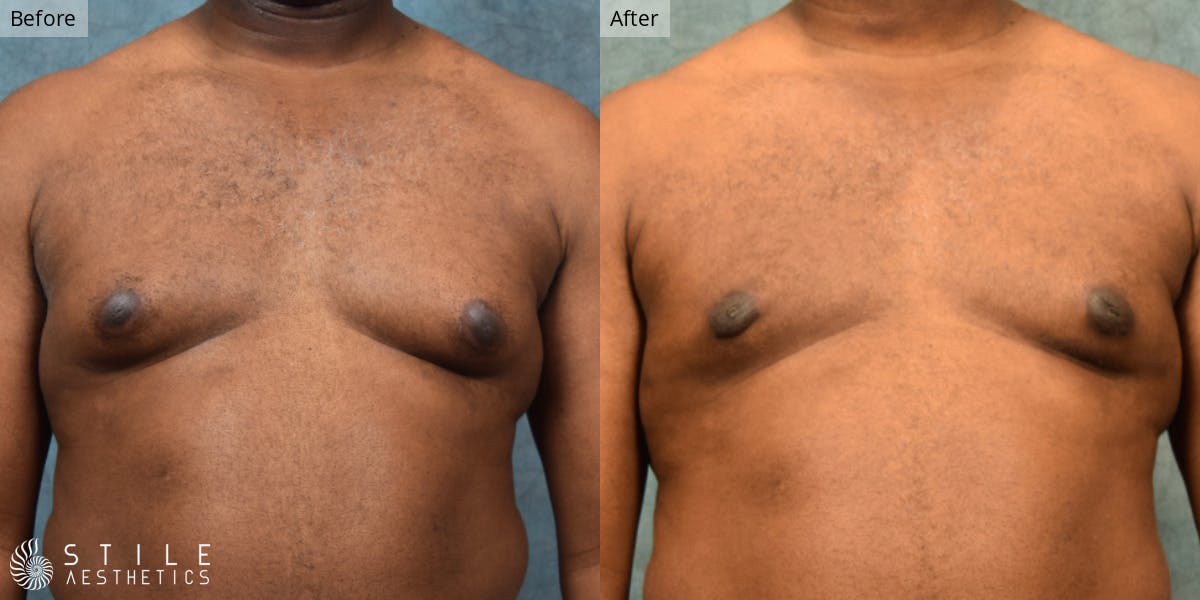 Gynecomastia Surgery Before & After Gallery - Patient 197027 - Image 2