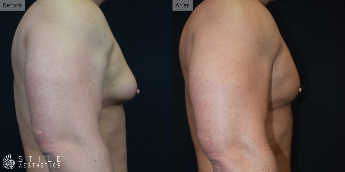 Gynecomastia Surgery Before & After Gallery - Patient 424268 - Image 1