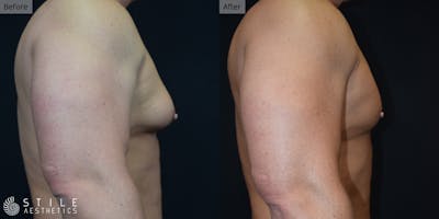 Gynecomastia Surgery Before & After Gallery - Patient 424268 - Image 1