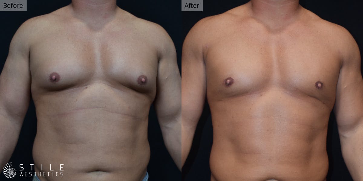 Gynecomastia Surgery Before & After Gallery - Patient 424268 - Image 2