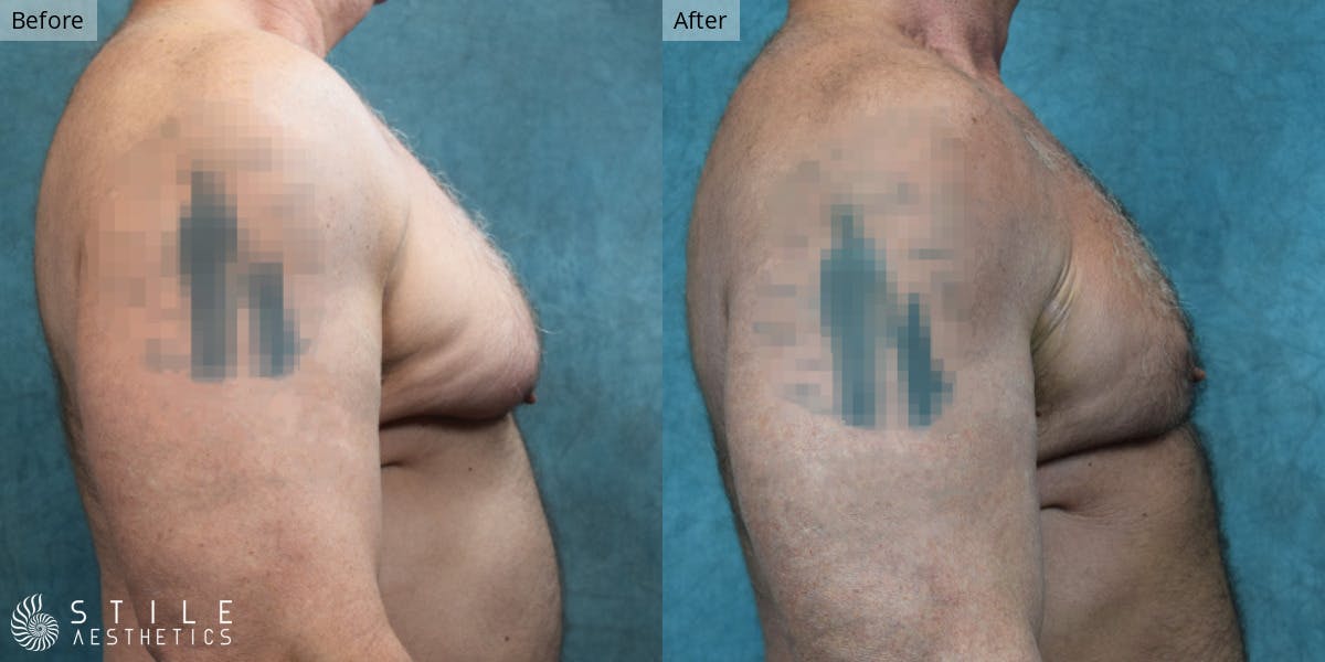 Gynecomastia Surgery Before & After Gallery - Patient 400786 - Image 1