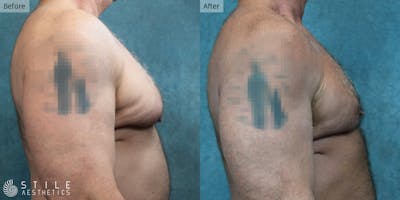 Gynecomastia Surgery Before & After Gallery - Patient 400786 - Image 1