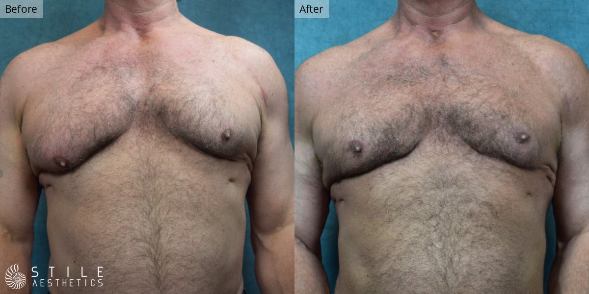 Gynecomastia Surgery Before & After Gallery - Patient 400786 - Image 2