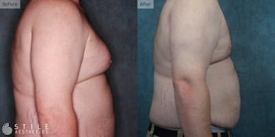 Gynecomastia Surgery Before & After Gallery - Patient 154706 - Image 1
