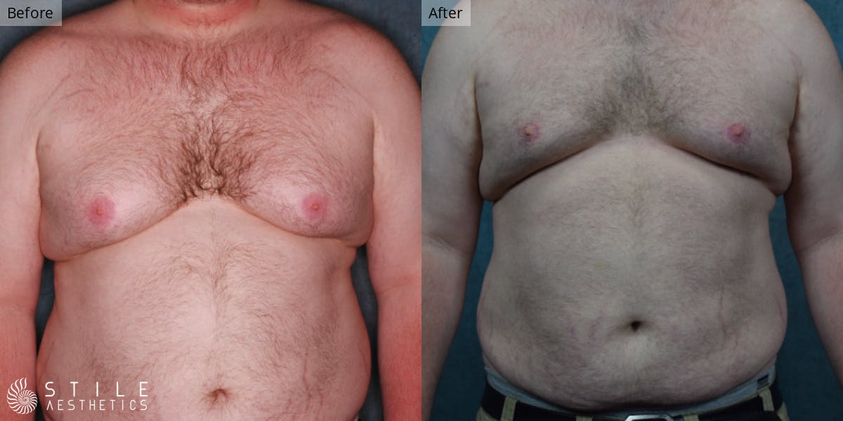 Gynecomastia Surgery Before & After Gallery - Patient 154706 - Image 2