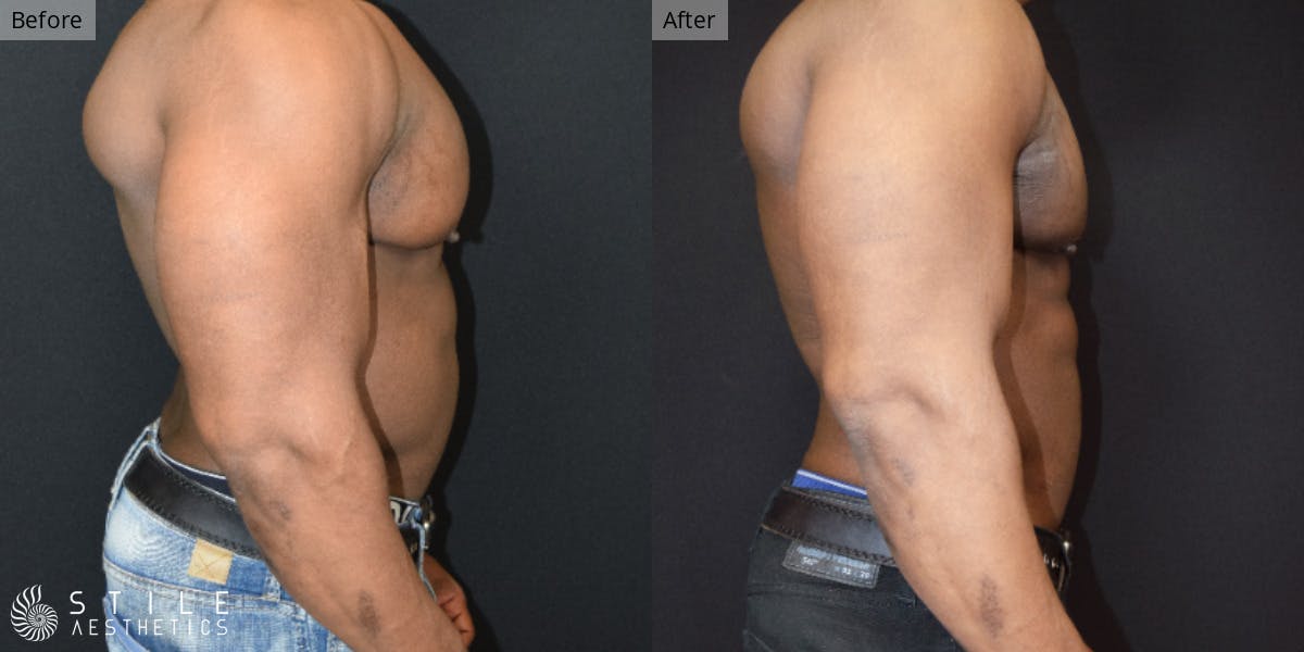 Gynecomastia Surgery Before & After Gallery - Patient 620078 - Image 1