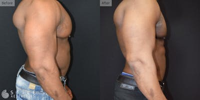 Gynecomastia Surgery Before & After Gallery - Patient 620078 - Image 1