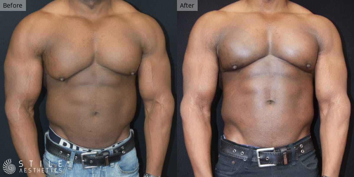 Gynecomastia Surgery Before & After Gallery - Patient 620078 - Image 2