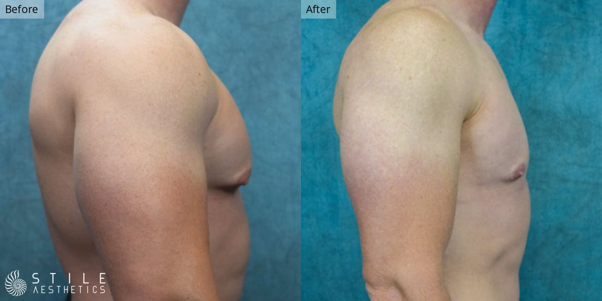 Gynecomastia Surgery Before & After Gallery - Patient 146029 - Image 1