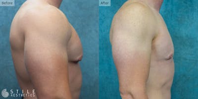 Gynecomastia Surgery Before & After Gallery - Patient 146029 - Image 1