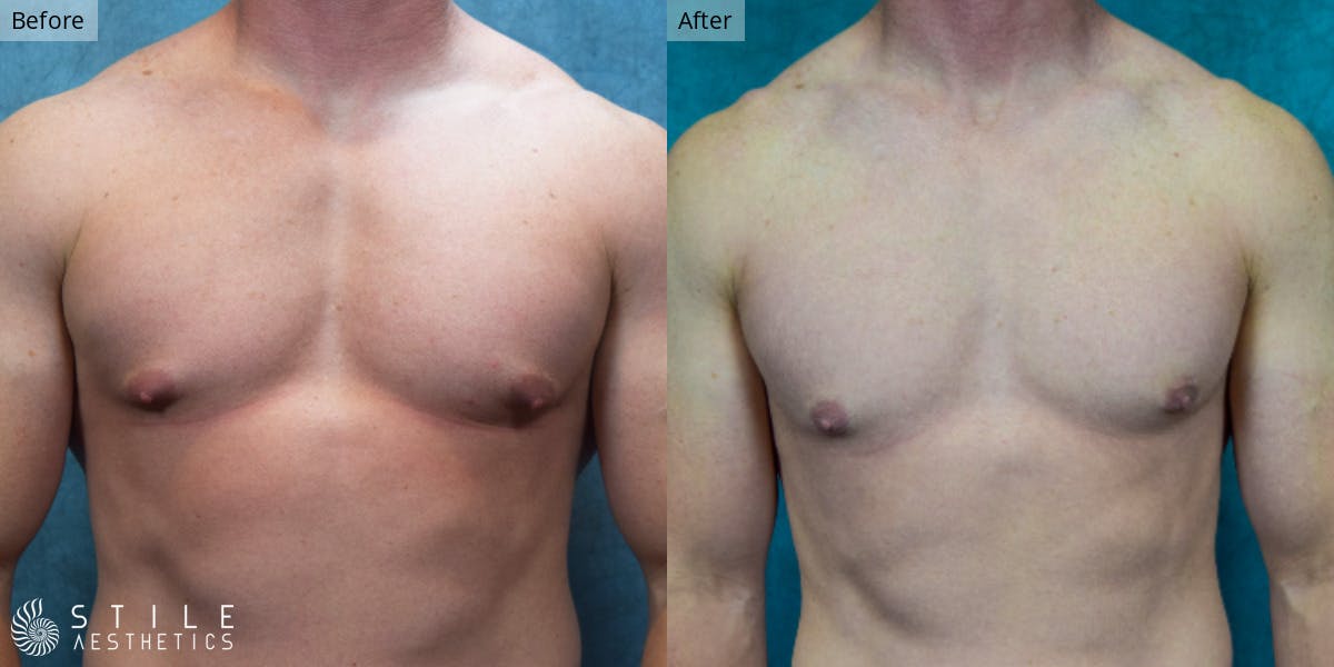 Gynecomastia Surgery Before & After Gallery - Patient 146029 - Image 2