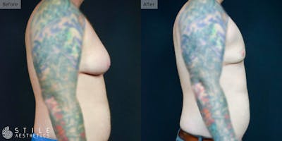 Gynecomastia Surgery Before & After Gallery - Patient 346232 - Image 1