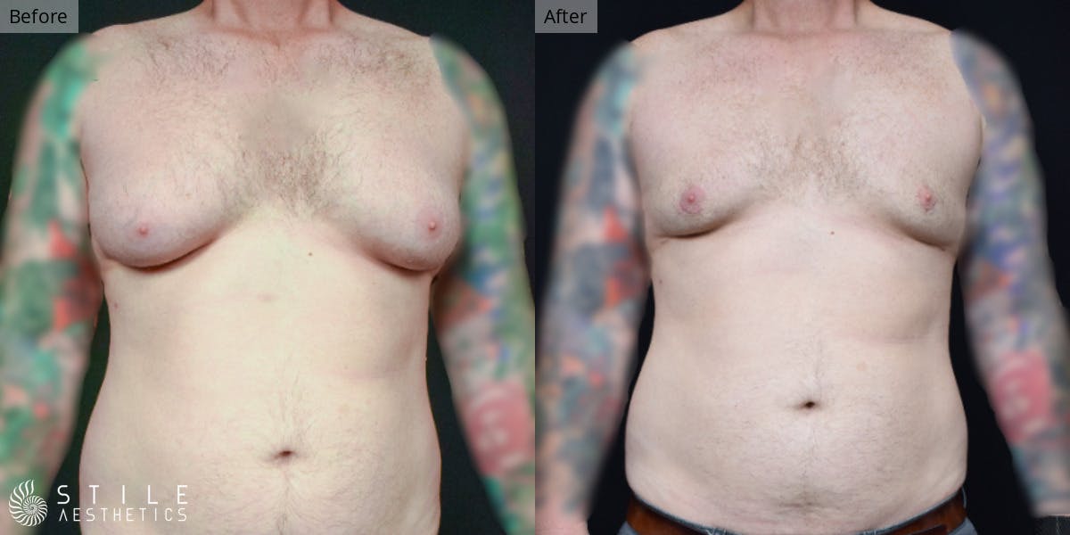 Gynecomastia Surgery Before & After Gallery - Patient 346232 - Image 2