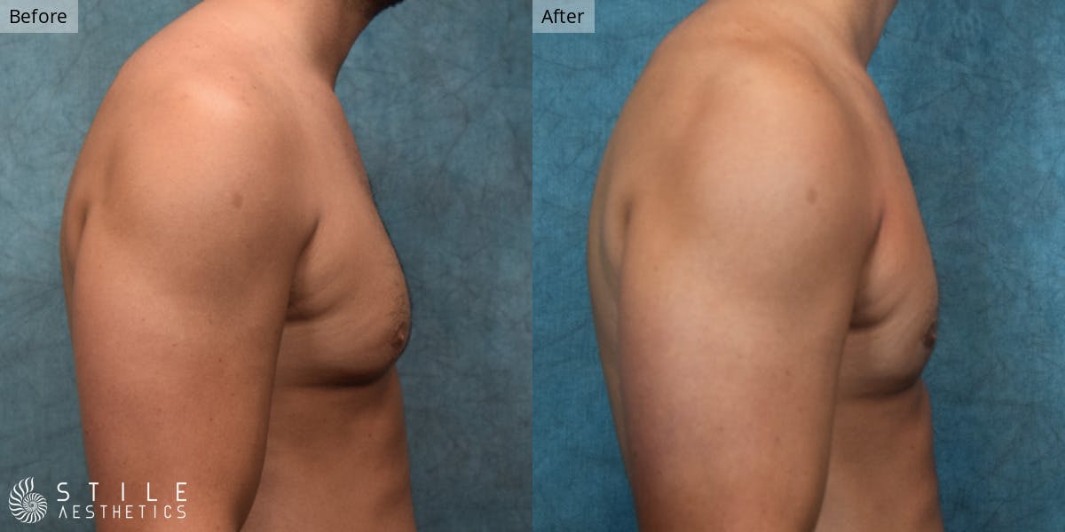 Gynecomastia Surgery Before & After Gallery - Patient 390468 - Image 1
