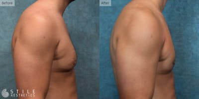 Gynecomastia Surgery Before & After Gallery - Patient 390468 - Image 1