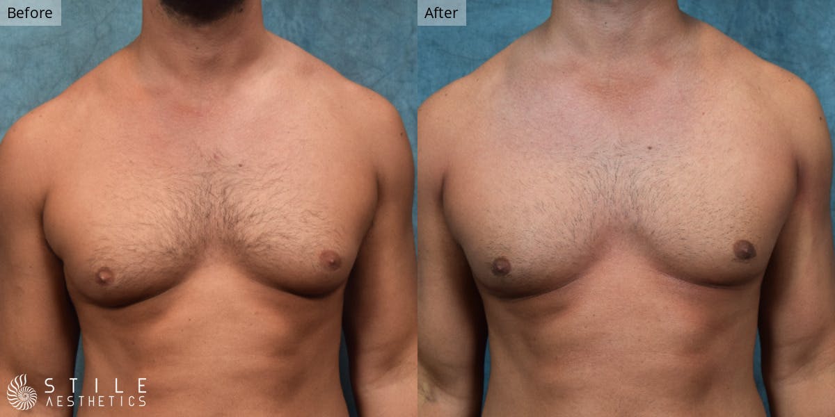 Gynecomastia Surgery Before & After Gallery - Patient 390468 - Image 2