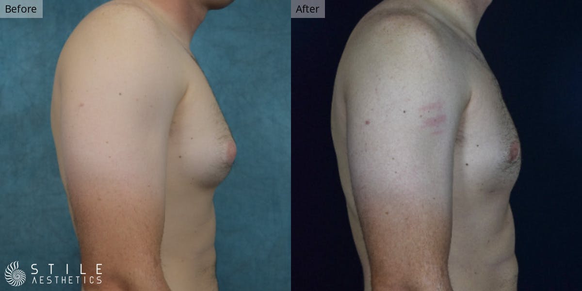 Gynecomastia Surgery Before & After Gallery - Patient 127779 - Image 1
