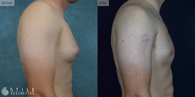 Gynecomastia Surgery Before & After Gallery - Patient 127779 - Image 1