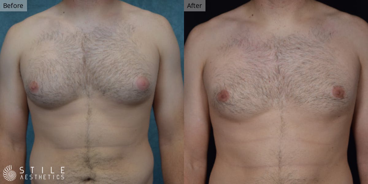 Gynecomastia Surgery Before & After Gallery - Patient 127779 - Image 2