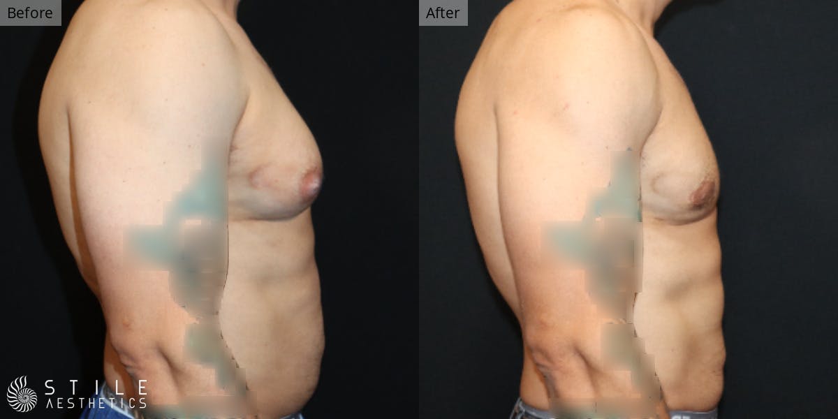 Gynecomastia Surgery Before & After Gallery - Patient 143380 - Image 1