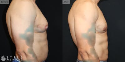 Gynecomastia Surgery Before & After Gallery - Patient 143380 - Image 1