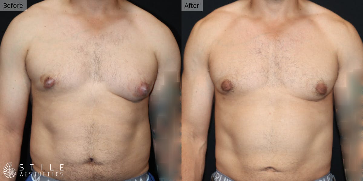 Gynecomastia Surgery Before & After Gallery - Patient 143380 - Image 2